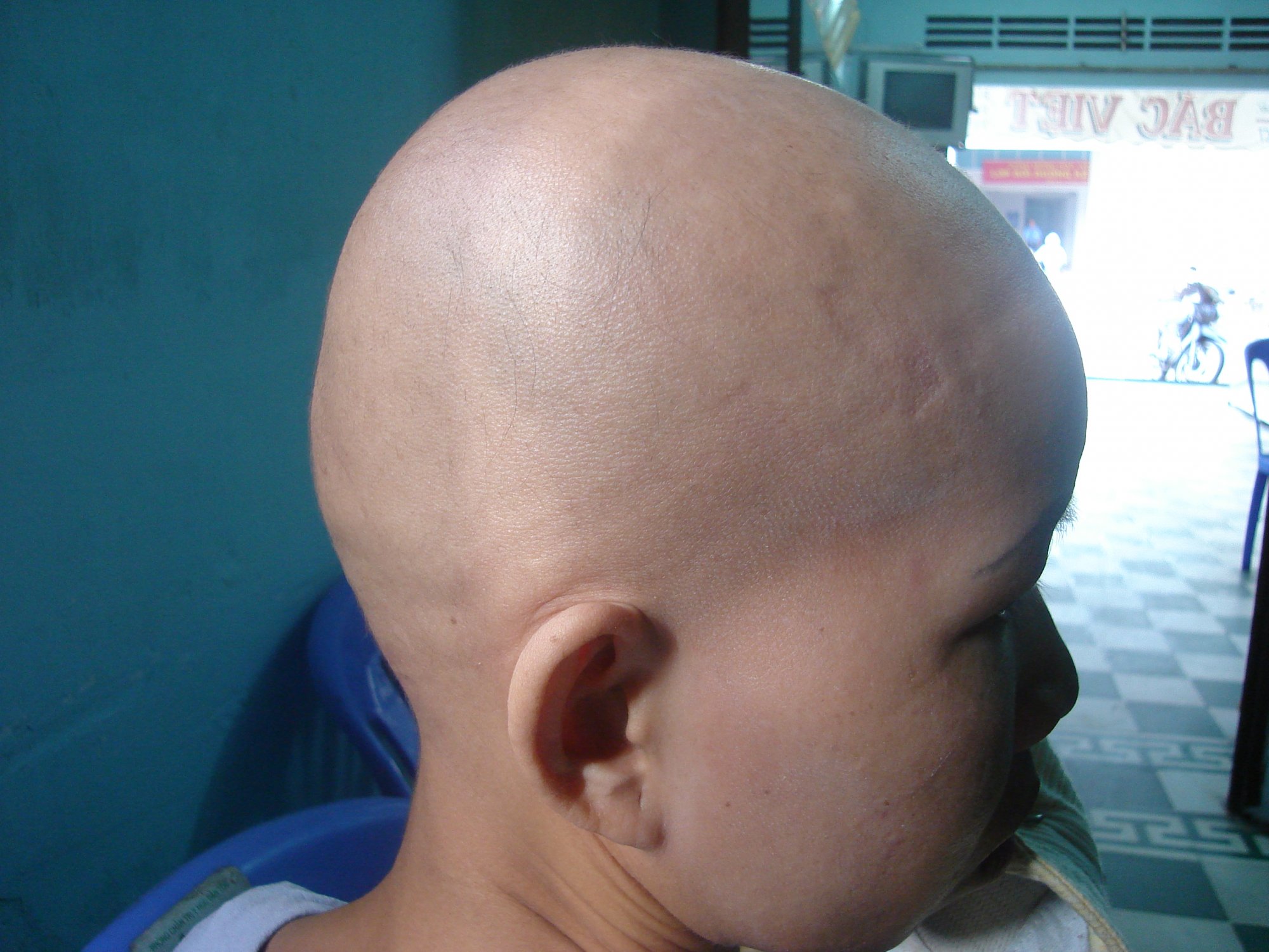 Phương Thuốc Trị Khỏi Bệnh Rụng Tóc