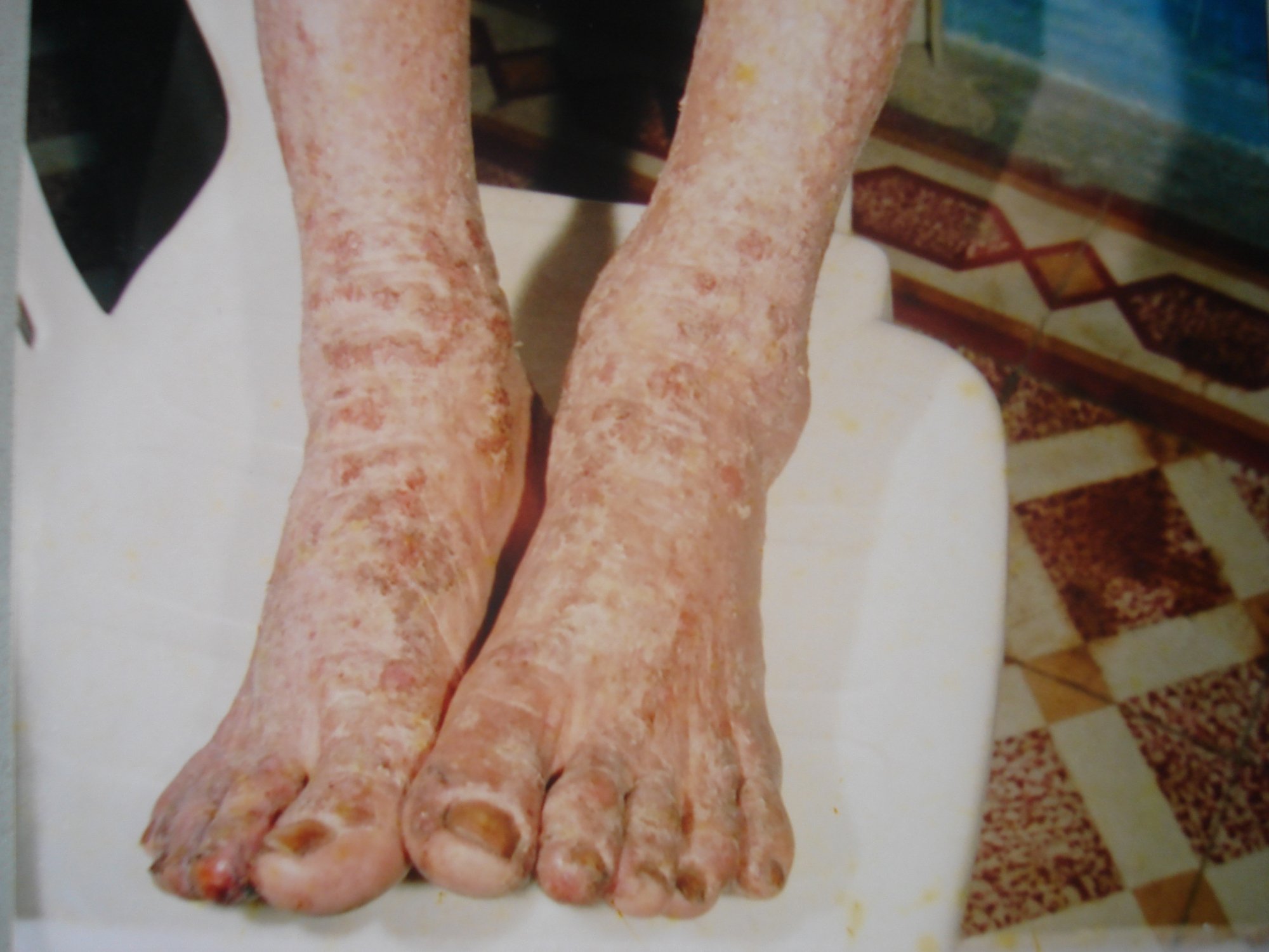 Phương Thuốc Chữa Khỏi Bệnh Chàm