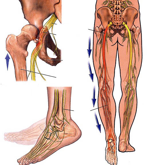 Bệnh đau thần kinh tọa và cột sống