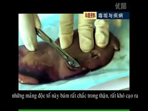 Video Các chất độc trong cơ thể cần loại trừ